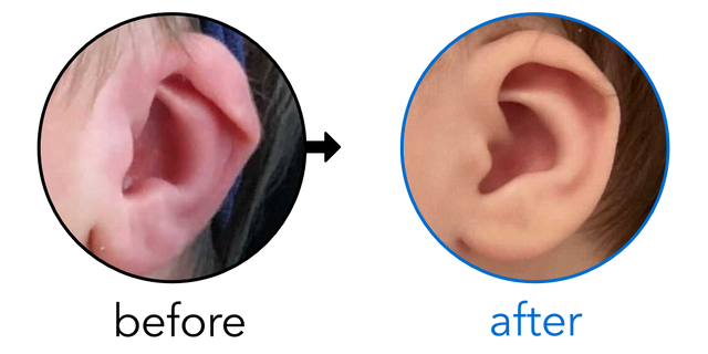 Before-and-after EarBuddies Lop Ear result; started at 3–6 months – Mrs. P