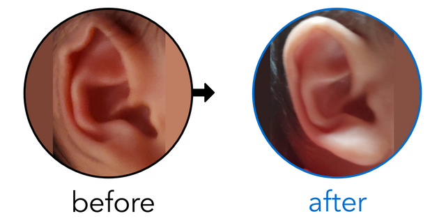 Before-and-after EarBuddies Rim Kink result; started within the first month – Rafaela & her Son