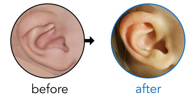 Before-and-after EarBuddies Lop Ear result; started at 3–6 months – Mrs L & her Daughter