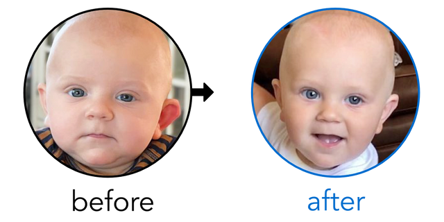 Before-and-after EarBuddies Stick-Out Ears result; started at 3–6 months – Sierra & her son Silas