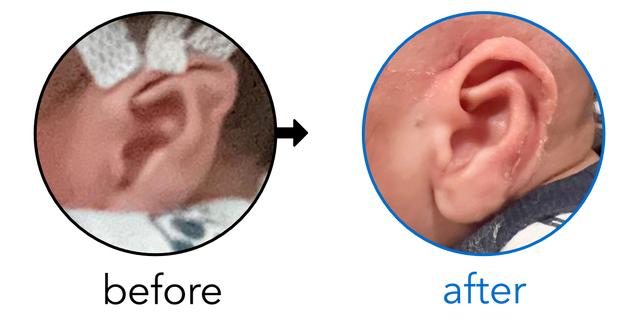 Before-and-after EarBuddies Stahl's Bar result; started within the first month – Kathleen & her son