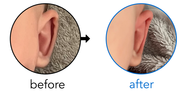 Before-and-after EarBuddies Stick-Out Ears result; started at 1–3 months – Sofia & her son