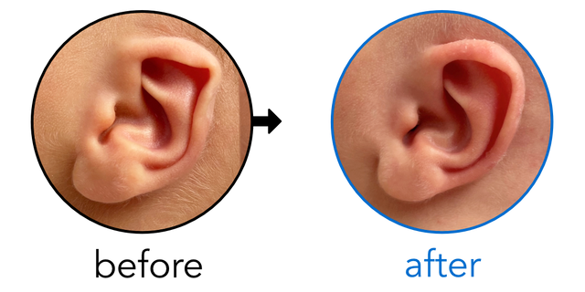 Before-and-after EarBuddies Folded-Over Helical Rim result; started within the first month – Artur & his son Kai