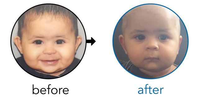 Before-and-after EarBuddies Stick-Out Ears result; started at 6–12 months – Amreen & her Daughter