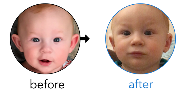 Before-and-after EarBuddies Stick-Out Ears result; started at 3–6 months – Elena, James & their Son Alessandro
