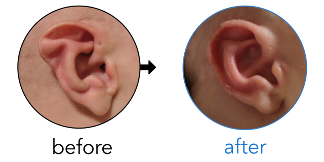 Before-and-after EarBuddies Stahl's Bar result; started within the first month – Brandi, Kirk & their son Griffin