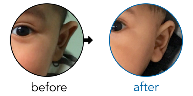 Before-and-after EarBuddies Stick-Out Ears result; started at 3–6 months – Abegail & her Son