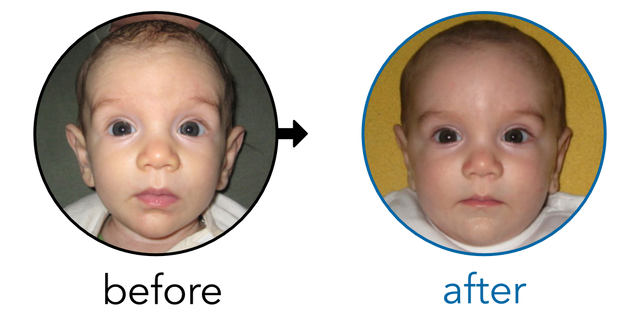 Before-and-after EarBuddies Stick-Out Ears result; started at 1–3 months – Alžběta & her children Lucie and Arthur