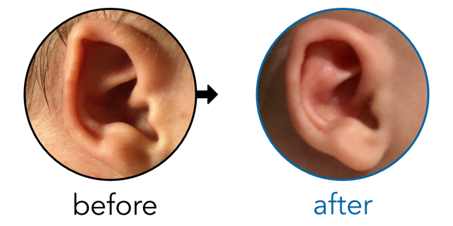 Before-and-after EarBuddies Folded-Over Helical Rim result; started at 1–3 months – Dani & her son Cody