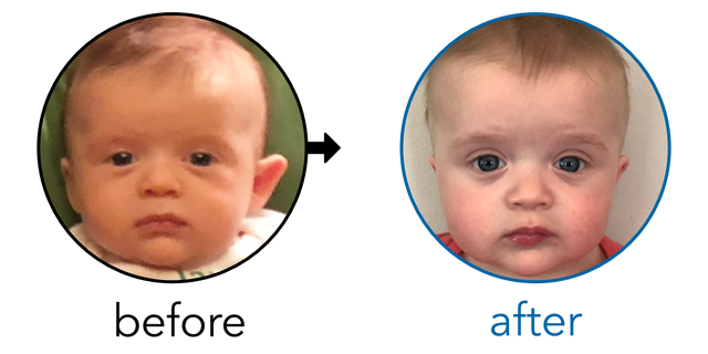 Before-and-after EarBuddies Stick-Out Ears result; started at 3–6 months – Lindsay & her Son Jasper
