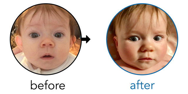 Before-and-after EarBuddies Stick-Out Ears result; started at 1–3 months – Lindsey & Baby Olivia