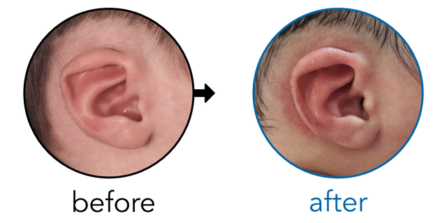 Before-and-after EarBuddies Lop Ear result; started within the first month – Boian, Natalie & Baby Gala