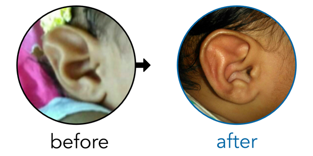 Before-and-after EarBuddies Stahl's Bar result; started at 1–3 months – Sarvesh, Kinari & their Daughter Nandika