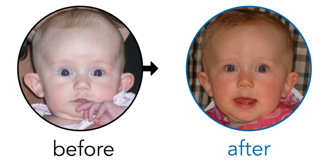 Before-and-after EarBuddies Stick-Out Ears result; started at 3–6 months – Christy & her Daughter