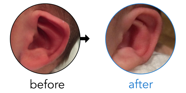 Before-and-after EarBuddies Lop Ear result; started within the first month – Dev & her Son