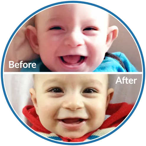 Prominent ears before and after newborn ear molding with EarBuddies ear splints.