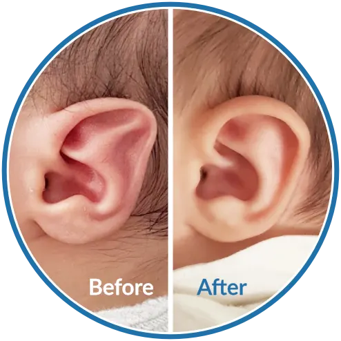 Stahl's Ear cartilage ridge before and after newborn ear molding with Ear Buddies