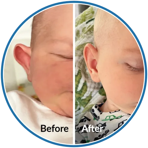 Protruding ear before and after newborn ear molding with EarBuddies ear splints