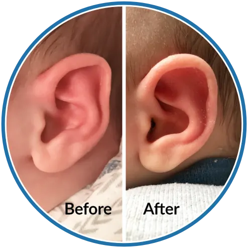 Folded over ear rim before and after infant ear molding with EarBuddies