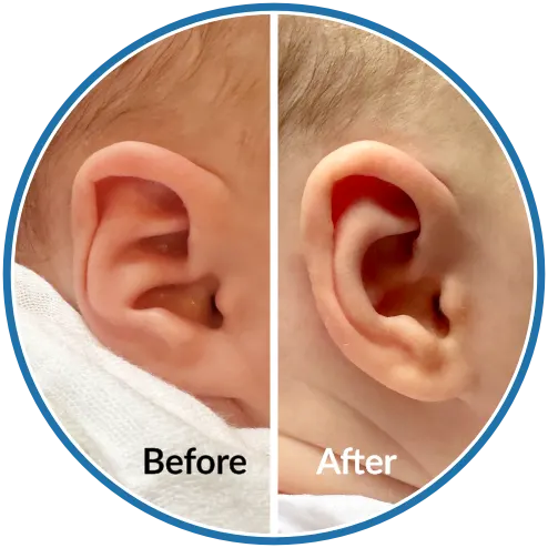 Conchal crus before and after infant ear molding with EarBuddies