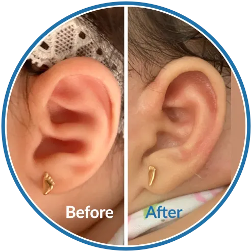 Conchal Crus before and after baby ear moulding with EarBuddies