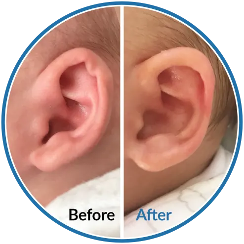 Rim kink before and after newborn ear molding with EarBuddies ear splints
