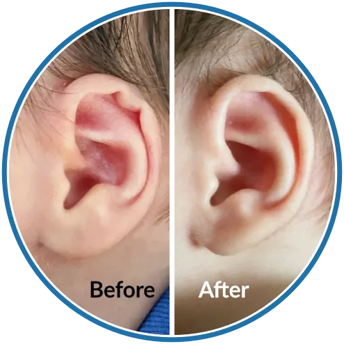 Rim kink ear shape before and after newborn ear molding with EarBuddies ear splints