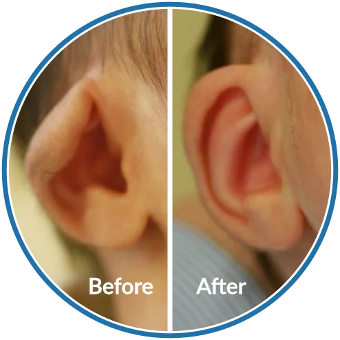 Lop Ear before and after infant ear moulding using EarBuddies