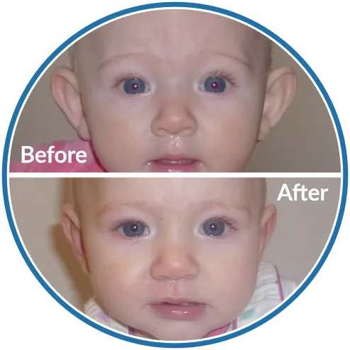 Baby Stick Out Ears before and after non-surgical ear correction with Ear Buddies