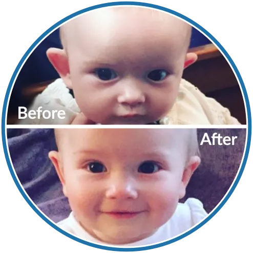Before and after baby ear moulding for Bat Ears with EarBuddies