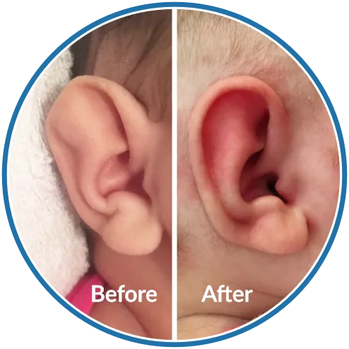 Baby ear shape before and after newborn ear splinting for Stahl's Bar with EarBuddies