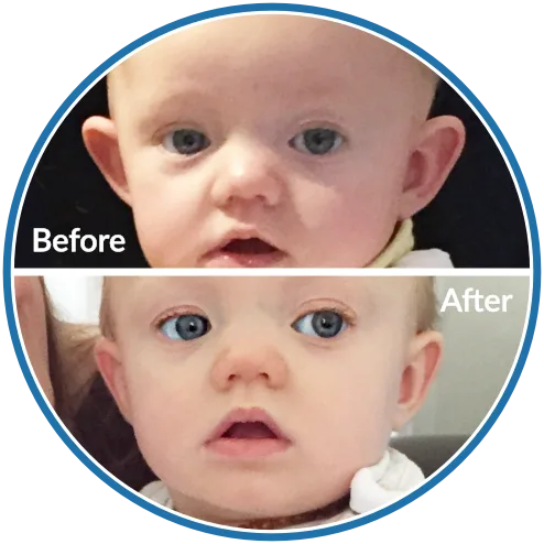 Protruding ears before and after infant ear molding with Ear Buddies