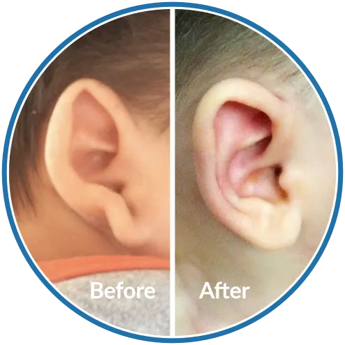 Folded ear cartilage before and after newborn ear moulding with EarBuddies for Stick Out Lobe