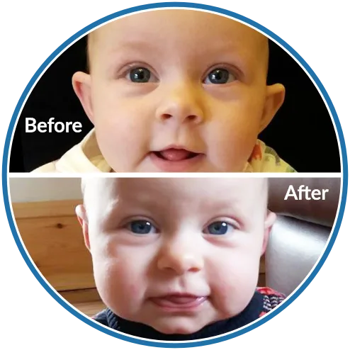 Prominent ears improvement before and after baby ear moulding with EarBuddies