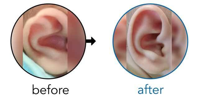 Before-and-after EarBuddies Stahl's Bar result; started at 1–3 months – Erica & her Daughter