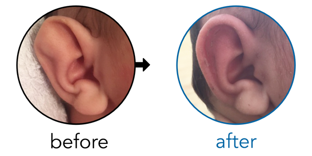 Before-and-after EarBuddies Stahl's Bar result; started at 1–3 months – Denise & her Daughter