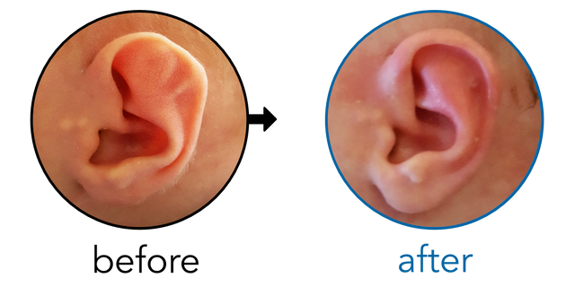 Before-and-after EarBuddies Stahl's Bar result; started within the first month – Sarah & her Son Ted