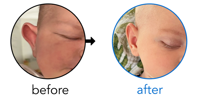Before-and-after EarBuddies Stick-Out Ears result; started within the first month – Genevieve, Chris, & baby Clay