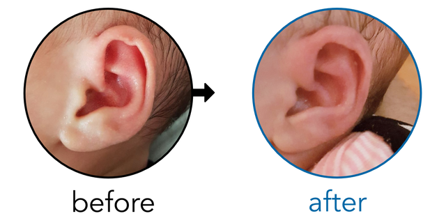 Before-and-after EarBuddies Rim Kink result; started at 1–3 months – Ibrahim & his Daughter Miray