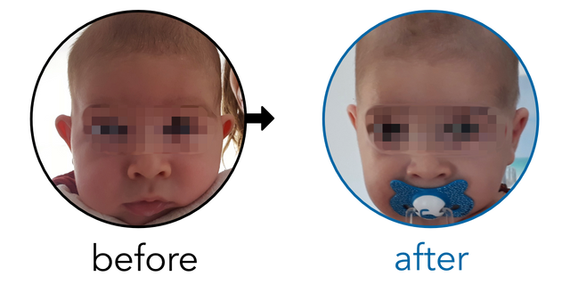 Before-and-after EarBuddies Stick-Out Ears result; started at 1–3 months – Andrea & her Son