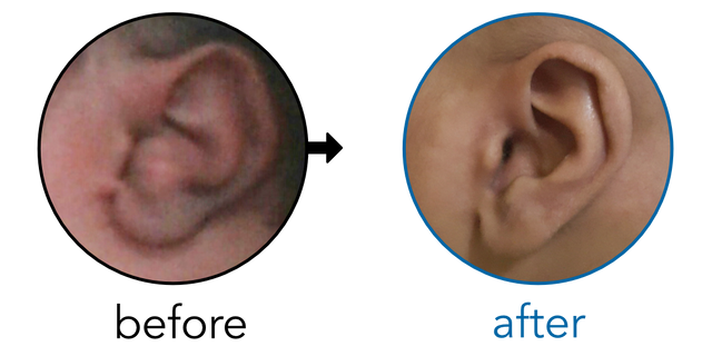 Before-and-after EarBuddies Conchal Crus result; started within the first month – Mrs N. & her Son