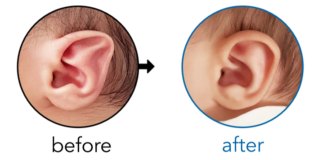 Before-and-after EarBuddies Stahl's Bar result; started within the first month – Emel & his Son