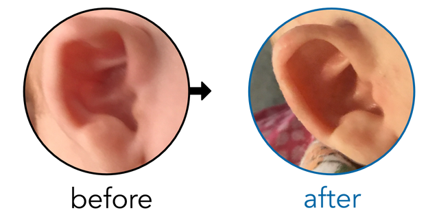 Before-and-after EarBuddies Stahl's Bar result; started at 1–3 months – Nicola & her Son