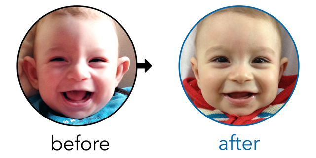 Before-and-after EarBuddies Stick-Out Ears result; started at 3–6 months – Cristina & her Son Santi