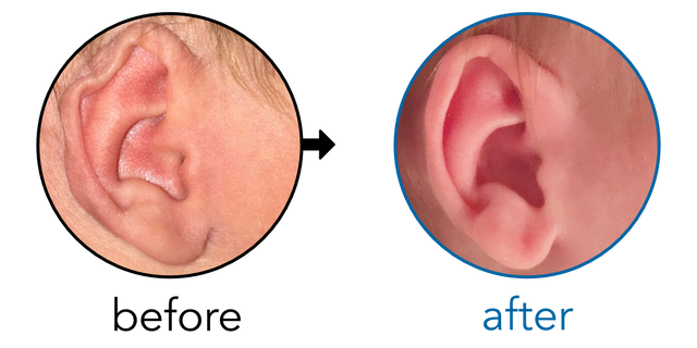 Before-and-after EarBuddies Rim Kink result; started within the first month – Mr. O, NHS Doctor