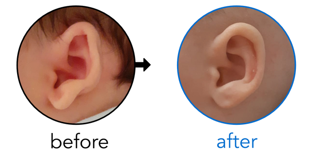 Before-and-after EarBuddies Stick-Out Lobe result; started at 1–3 months – Kristina & her son Aron