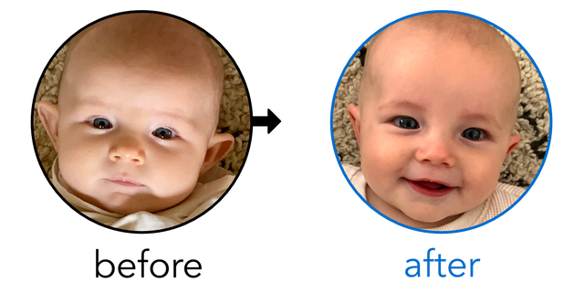 Before-and-after EarBuddies Stick-Out Ears result; started at 1–3 months – Kinzie & her Daughter Tess