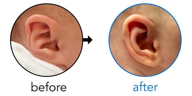 Before-and-after EarBuddies Conchal Crus result; started within the first month – Olivia & her daughter Isadora