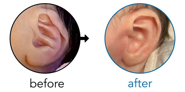 Before-and-after EarBuddies Conchal Crus result; started within the first month – Alyssa & her daughter