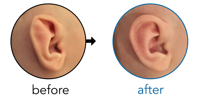 Before-and-after EarBuddies Stahl's Bar result; started at 1–3 months – Erin & her Son Augie